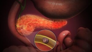 necrosis pancreática